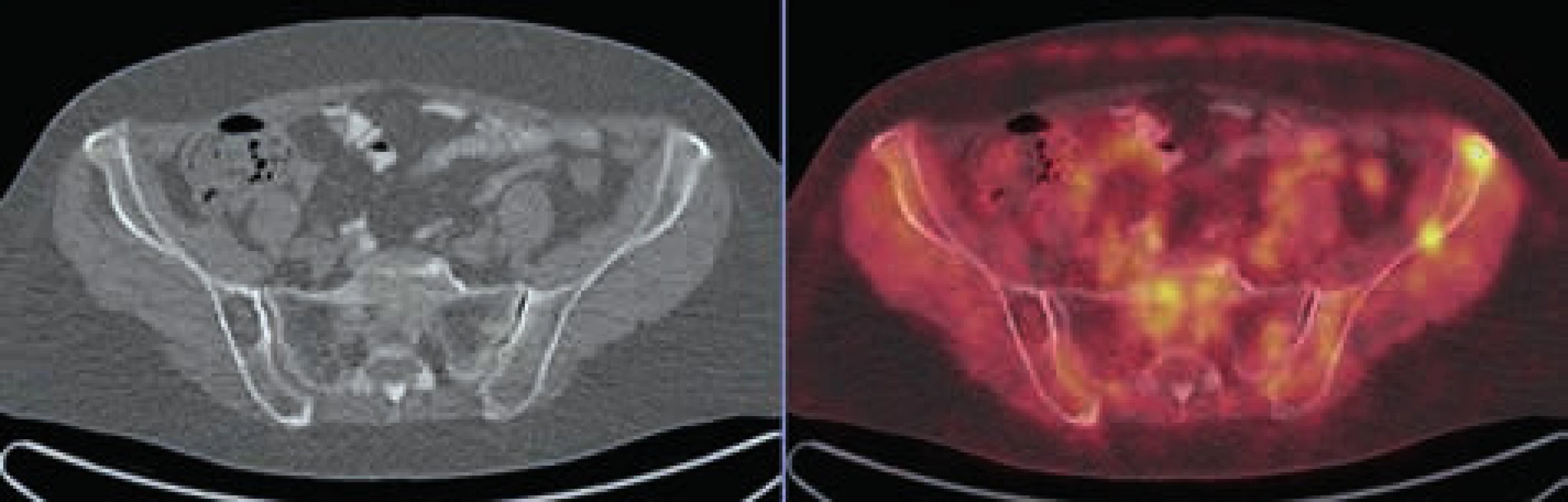 V levé lopatě kyčelní v LD CT obrazu evidentní osteolytická léze bez metabolického korelátu v PET obrazu, v pravé lopatě kyčelní naopak 2 drobná ložiska akumulace FDG bez jednoznačného korelátu v LD CT obrazu