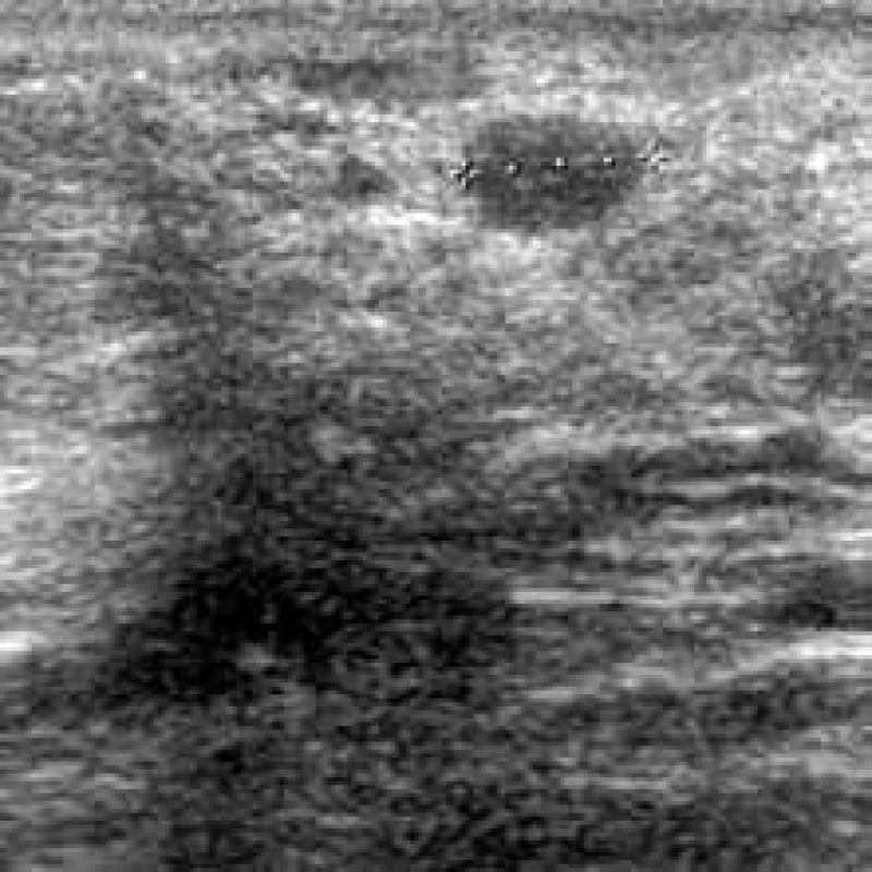 Nepravidelná nehomogenní area s mohutným akustickým stínem v pravé části obrazu. Vlevo oválné, poměrně dobře ohraničené ložisko – histologicky recidiva karcinomu.