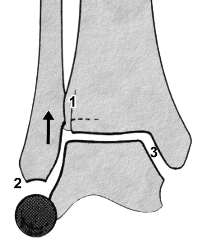 Hodnocení postavení distální fibuly pomocí Weberova nosu aWeberova kruhu (Volně podle [39]) 1 – Weberův nos, 2 – Weberův kruh, 3 – mediální kloubní štěrbina. V tomto případě je fibula dislokována proximálně, Weberův nos nekoresponduje s okrajem kloubní plochy distální tibie, je porušen Weberův kruh a rozšířena mediální kloubní štěrbina.