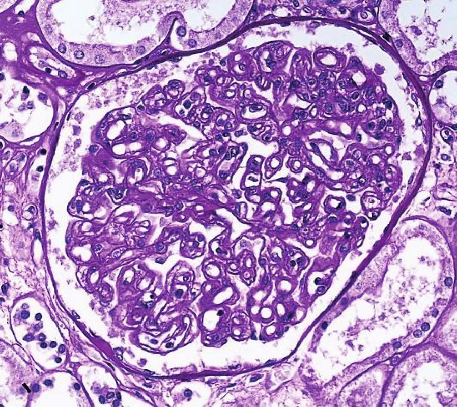 Transplantační glomerulopatie, která je výsledkem dlouhodobého poškození endotelu, na které mesangium reaguje formací druhé vnitřní bazální membrány a morfologicky se vytvoří tzv. dvojkontury GBM (šipka, PAS, objektiv 40x).
