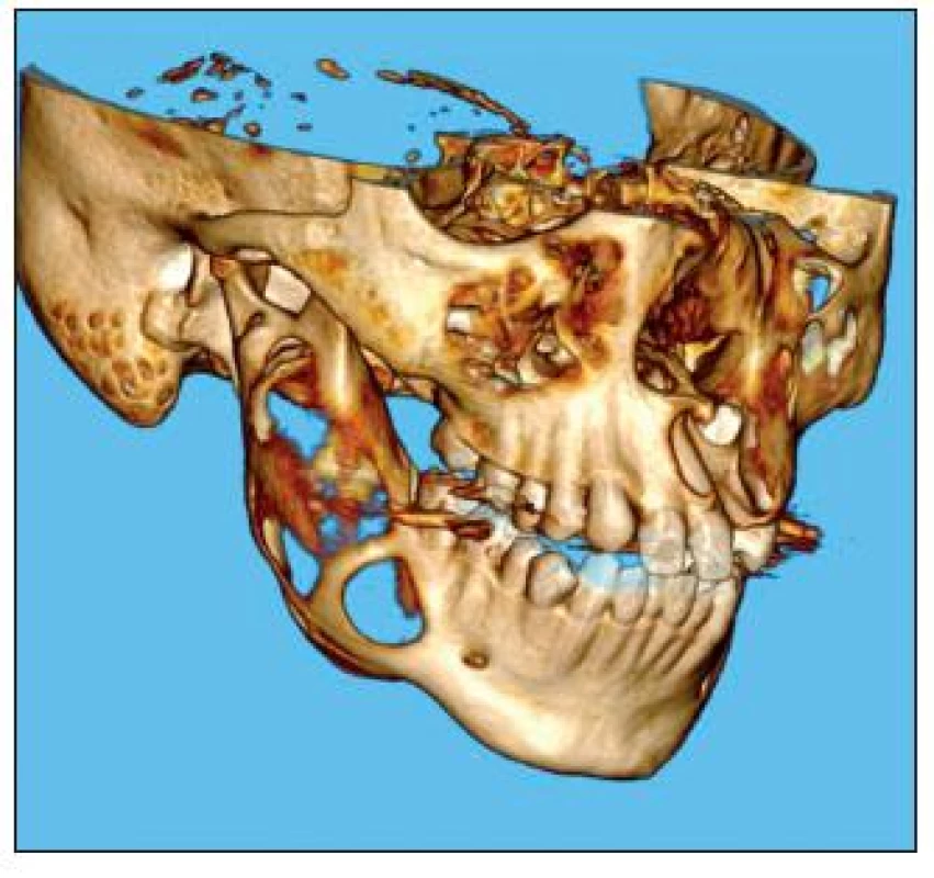 Na 3D CT rekonstrukci je jasně patrná již resorbovaná kompakta větve dolní čelisti