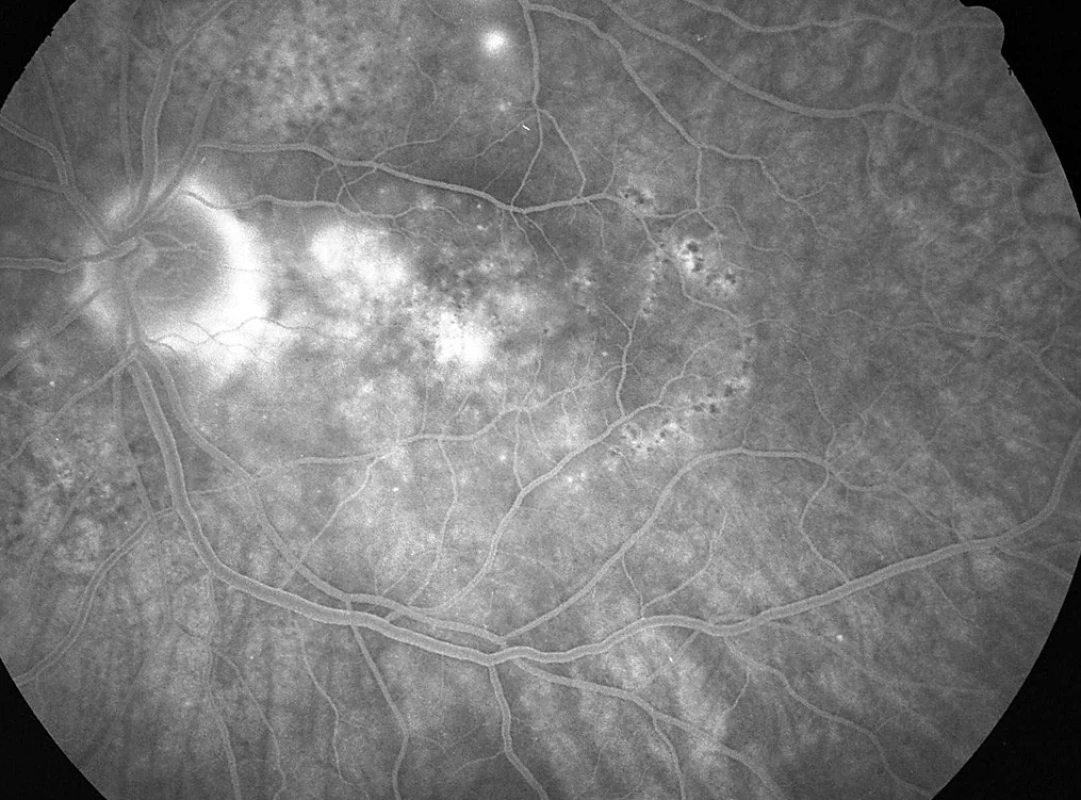 Pac. č. 5: Fluoresceínová angiografia ĽO po 2 týždňoch: pri TZN sa zvýrazňuje škvrnitá hyperfluorescencia s jemným presakováním, ablacia neuroepitelu retiny je takmer priložená, prítomná je rozsiahla porucha RPE. 2 body nad makulou ešte so zjavným presakovaním