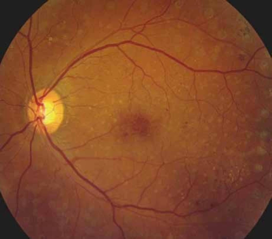 Barevná fotografie sítnice levého oka s cystoidním makulárním edémem z března roku 2010.