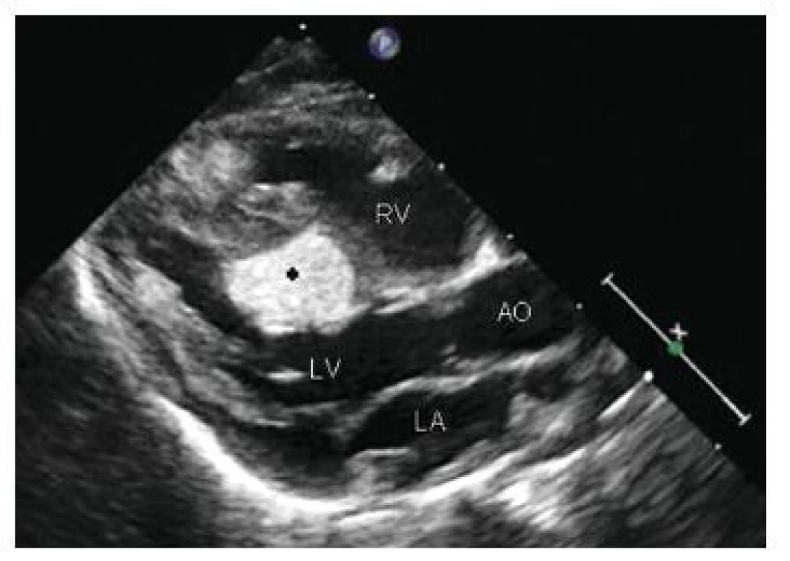 Objemný rhabdomyom (*) vycházející ze septa levé komory (LV) a další mnohočetné hyperechogenní rhabdomyomy ve stěně a septu pravé komory (RV) a úponu mitrální chlopně na echokardiografickém vyšetření pacienta s tuberózní sklerózou LA – levá síň, AO – aorta [18].