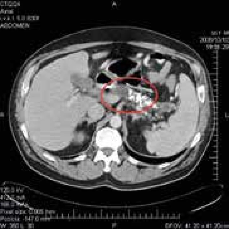 CT brucha pri 2. hospitalizácii s nálezom kalcifikátov v pankrease a pseudocysty hlavy pankreasu