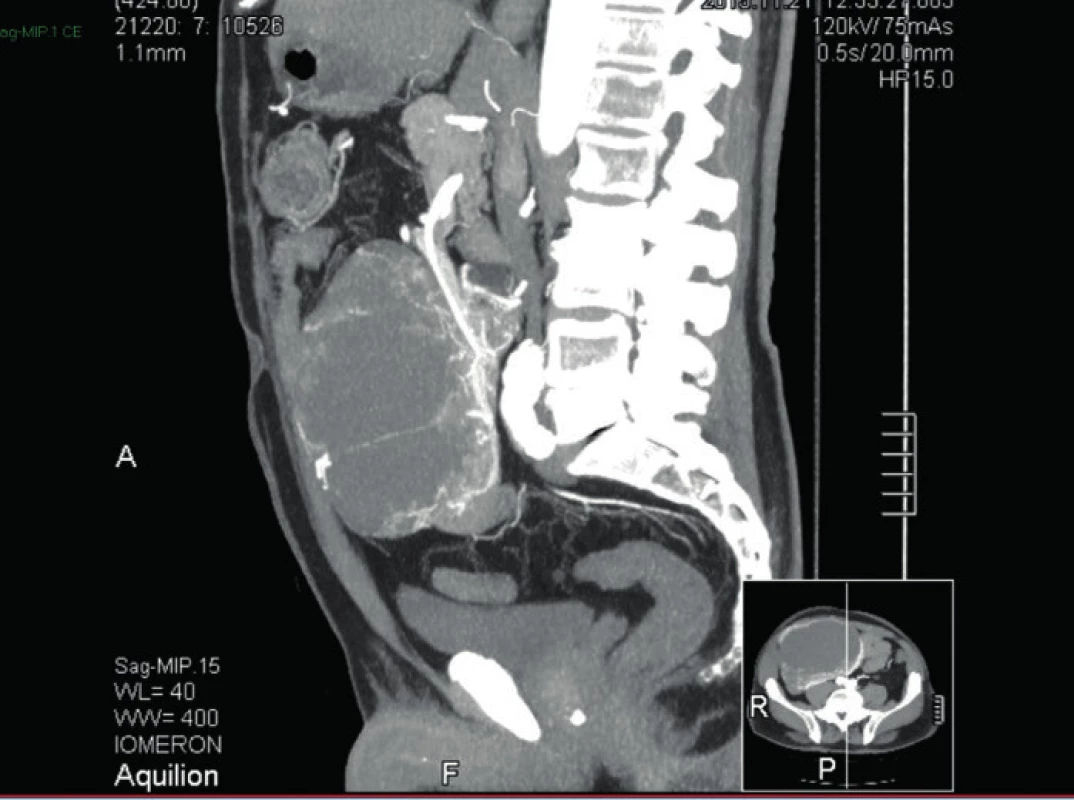 CT břicha a malé pánve MIP (maximum intensity projection ) v sagitální rovině
Fig. 5: CT scan of abdomen and pelvis MIP (maximum intensity projection ) sagittal view