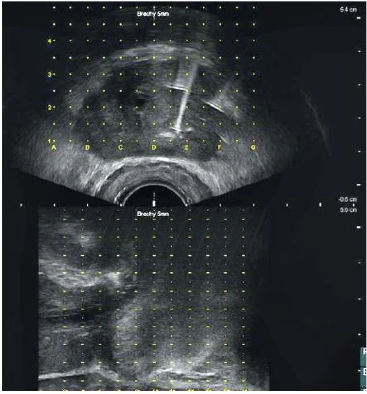 UZ obraz prostaty s rastrem brachyterapeutického gridu