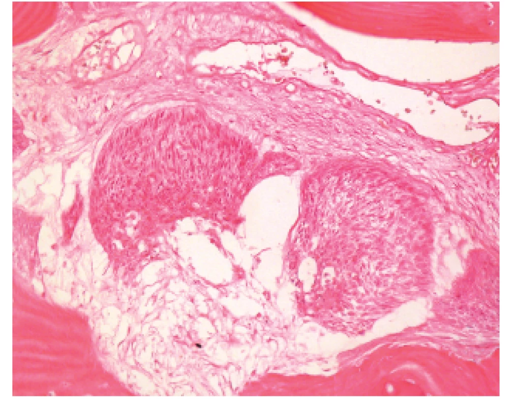 Detail na inváziu karcinómu do kostených štruktúr kalvy (H&amp;E, zvačšenie 240 x).