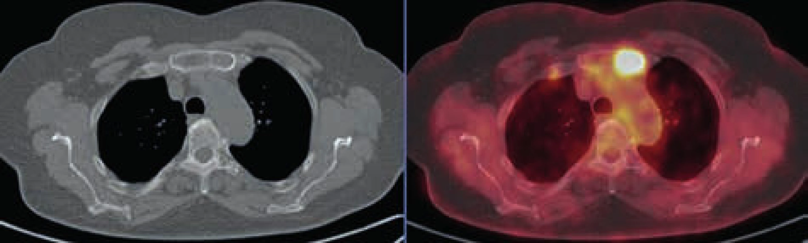 Osteolytické ložisko v levé polovině sterna vykazuje pozitivitu v PET obrazu