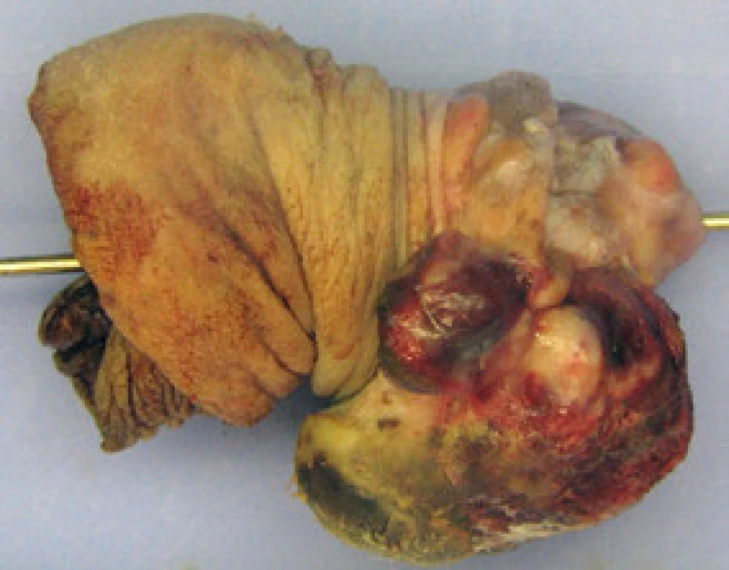 Amputát penisu – makroskopicky patrný exofytický tumor glandu přecházející na vnitřní list předkožky (foto R. Žalud)
Fig. 1. Tumour of glans penis on removed part of penis (Photo R. Žalud)