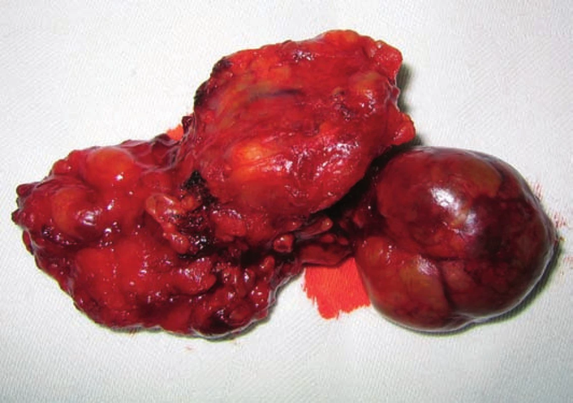 Operační preparát: dva nádorové uzly s částí povrchového listu gl. parotis