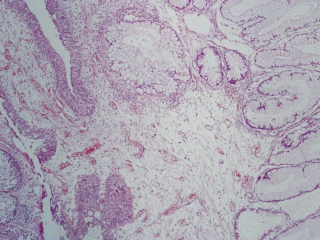 Sliznice močového měchýře vlevo kryta urotelem, vpravo intestinální metaplazie s pohárkovými buňkami (hematoxylin-eosin, zvětšení 40x)
Fig. 4. Bladder mucosa on the left side covered with normal urothelium, right intestinal metaplasia with goblet cells (hematoxylin-eosin, 40x)