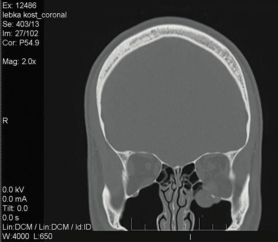 CT snímek zlomeniny levé očnice - koronární řez