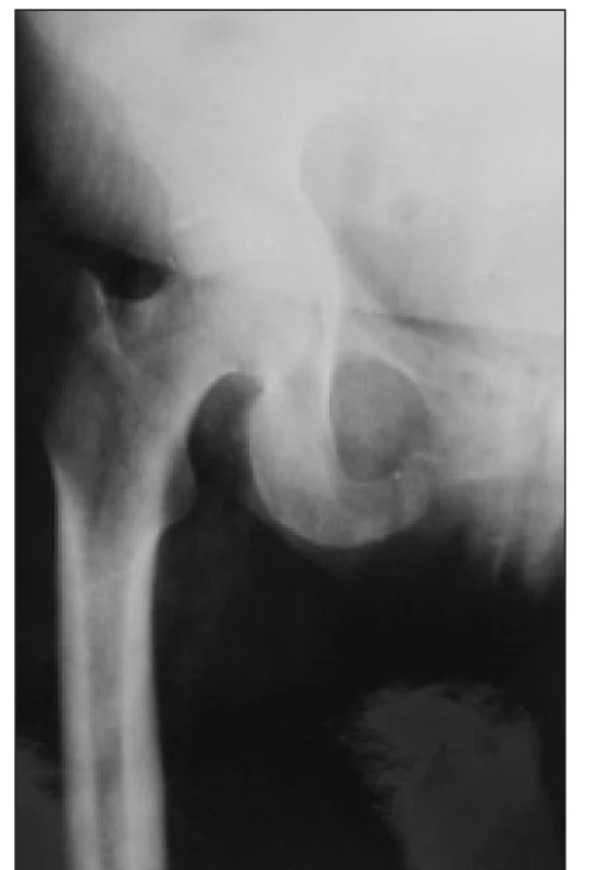 Pseudofraktura na rameni stydké kosti při osteomalacii, tzv. Looserova zóna.