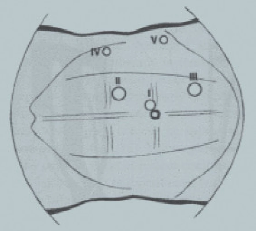 Transperitoneální laparoskopie v horním retroperitoneu. Uspořádání trokarů na pravé straně.