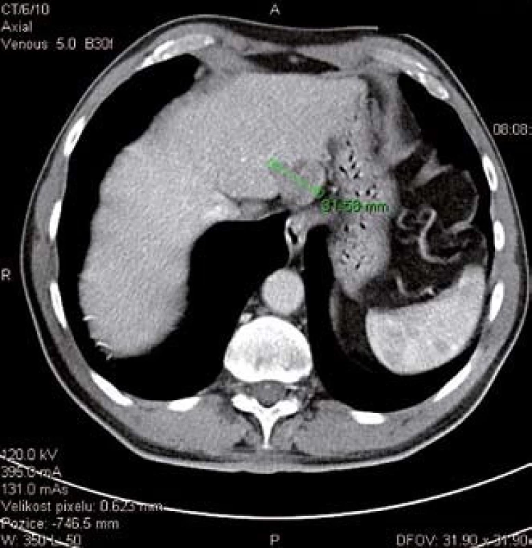 CT snímek HCC v levém jaterním laloku.
Fig. 1. CT scan of HCC in left liver lobe.