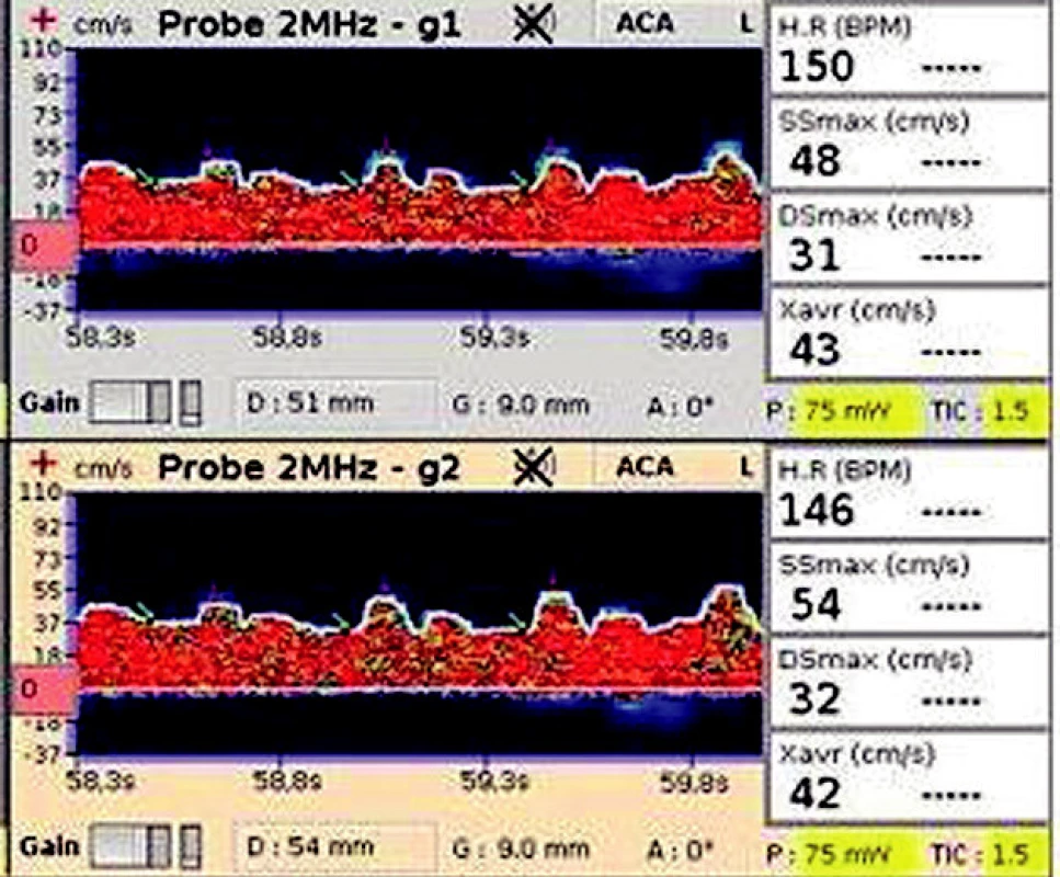 TCD záznam na a. cerebri media Zobrazuje nízké maximální rychlosti v systole a diastole (SSmax a DSmax ) s malou diferencí mezi těmito rychlostmi svědčící pro porušenou mozkovou autoregulaci.