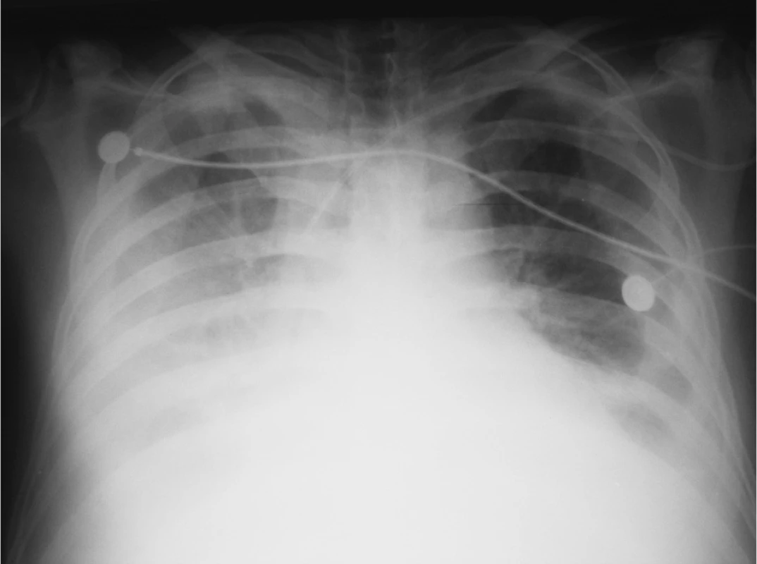  RTG plic – oboustranný fluidotorax
Fig. 2. Pulmonary x-ray – bilateral fluidothorax