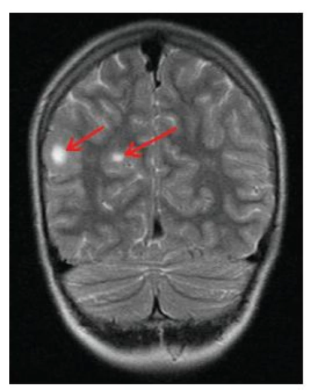 Kortiko-subkortikální tubery (šipky) na MR vyšetření mozku v T2 vážených obrazech u 17letého chlapce