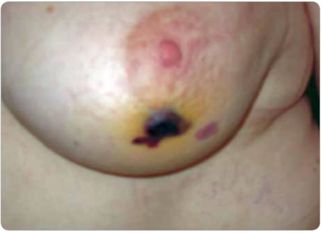 Postradiační hemangiosarkom (pacient č. 2). Tmavě červené až černé nepravidelné ložisko cca 3 mm nad niveau, další červené ploché ložisko v jeho blízkosti mediálně.
