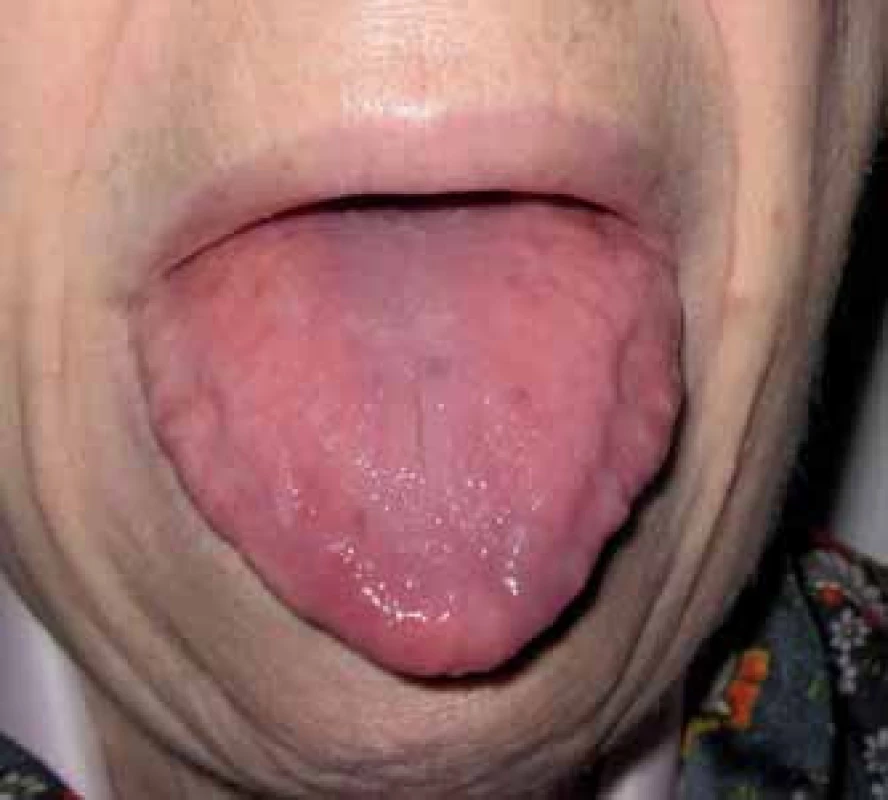 Makroglosie jako projev systémové AL-amyloidózy.
Po stranách jazyka jsou patrné otisky zubů. Vymizení chuti a obtížný příjem potravy jsou v současné době nejvýraznějšími problémy pacientky.
