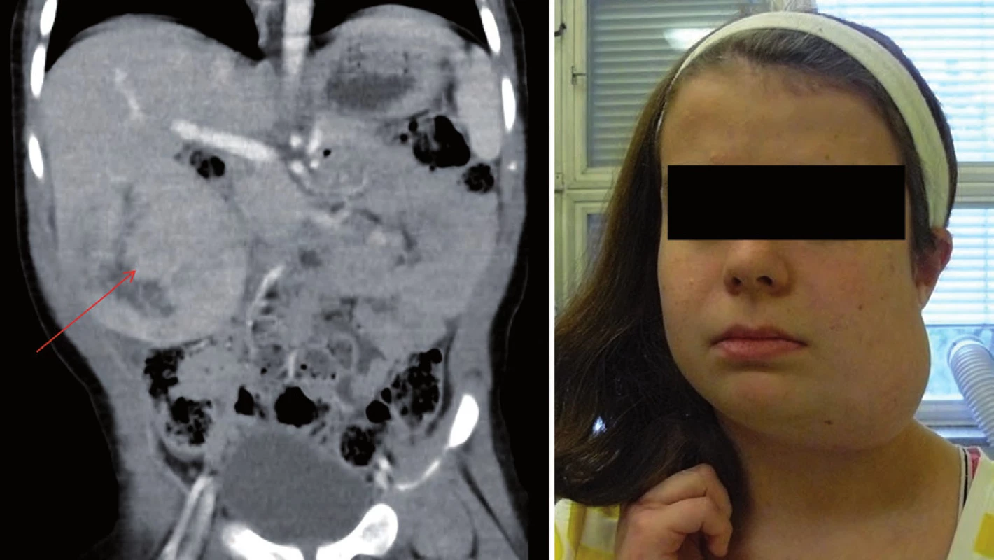 Familiární adenomatózní polypóza. A. obraz hepatoblastomu u chlapce ve věku 16 měsíců; 
B. osteom čelisti u dívky, věk 10 let.
