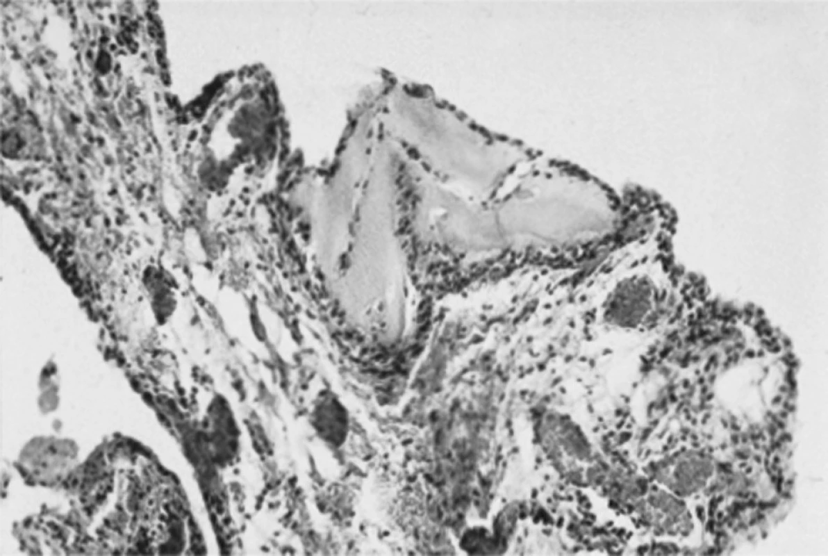 Histologie synoviální membrány: V nálezu převažují fragmenty chrupavkové a kostní tkáně nepravidelného tvaru uložené v synoviální membráně, jak tomu bývá u sekundární osteochondromatózy.