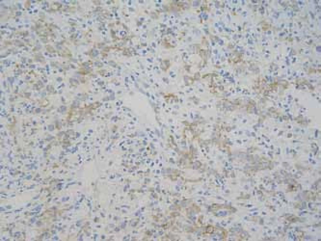 Barvení na cytokeratiny AE 1–3; zvětšení 200×, hnědá pozitivita epitelu krypt a nádorových buněk.