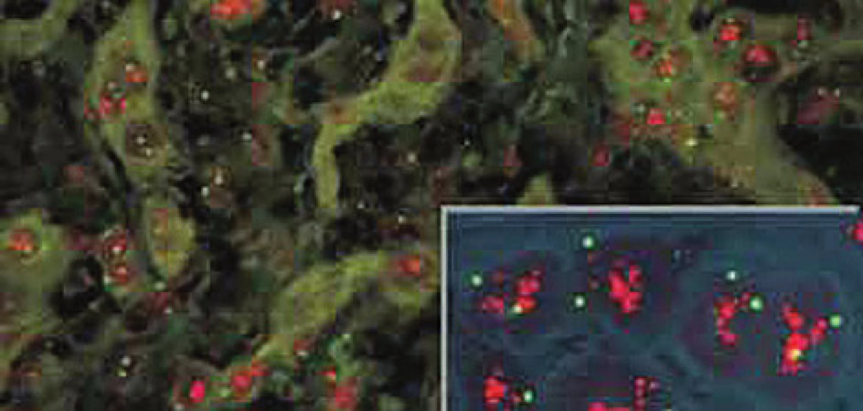 V případech silné amplifikace genu HER2 je počet červených signálů někdy tak vysoký, že dochází k jejich splývání ve formě objemných shluků. Vnitřní kontrolou je normální (tj. 2 kopie) počet zelených centromerických signálů (dle www.patologie.info.cz)