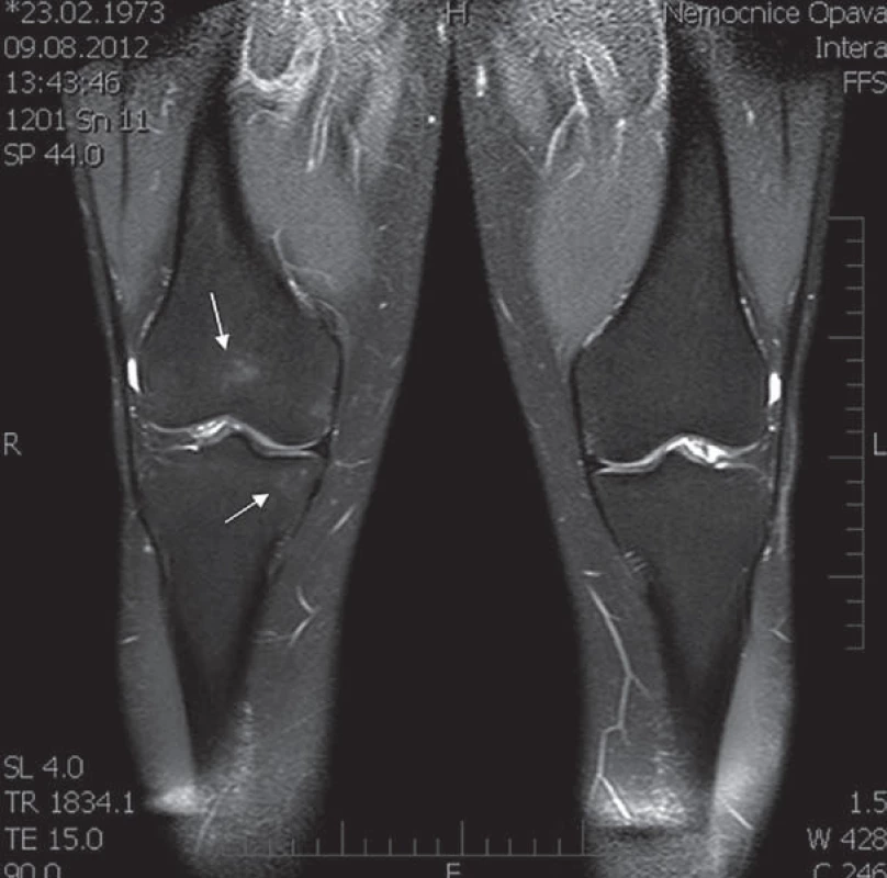 MRI kolenních kloubů (srpen roku 2012). Diskrétní ložiska kostního edému v distální epifýze pravého femuru a proximální epifýze tibie, naznačená pouze v sekvenci s potlačením tuku (ložiska edému nebyla popsána na CT obraze v roce 2011).