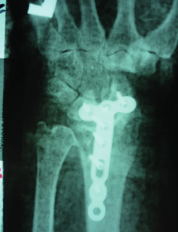 Rentgenový snímek zápěstí po radioskafolunátní artrodéze