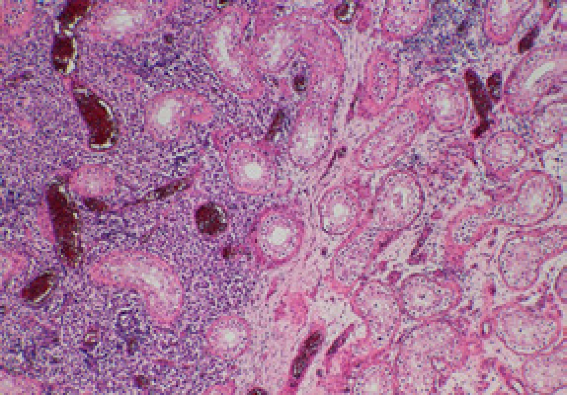 Histologický preparát – vpravo IGCNU, vlevo infiltrace seminomem (Hematoxylin – eosin, zvětšení 40 x, foto Radim Žalud)
Fig. 4. Histological specimen – IGCNU on the right, seminoma on the left (Hematoxylin – eosin, magnification 40 x, photo Radim Žalud)