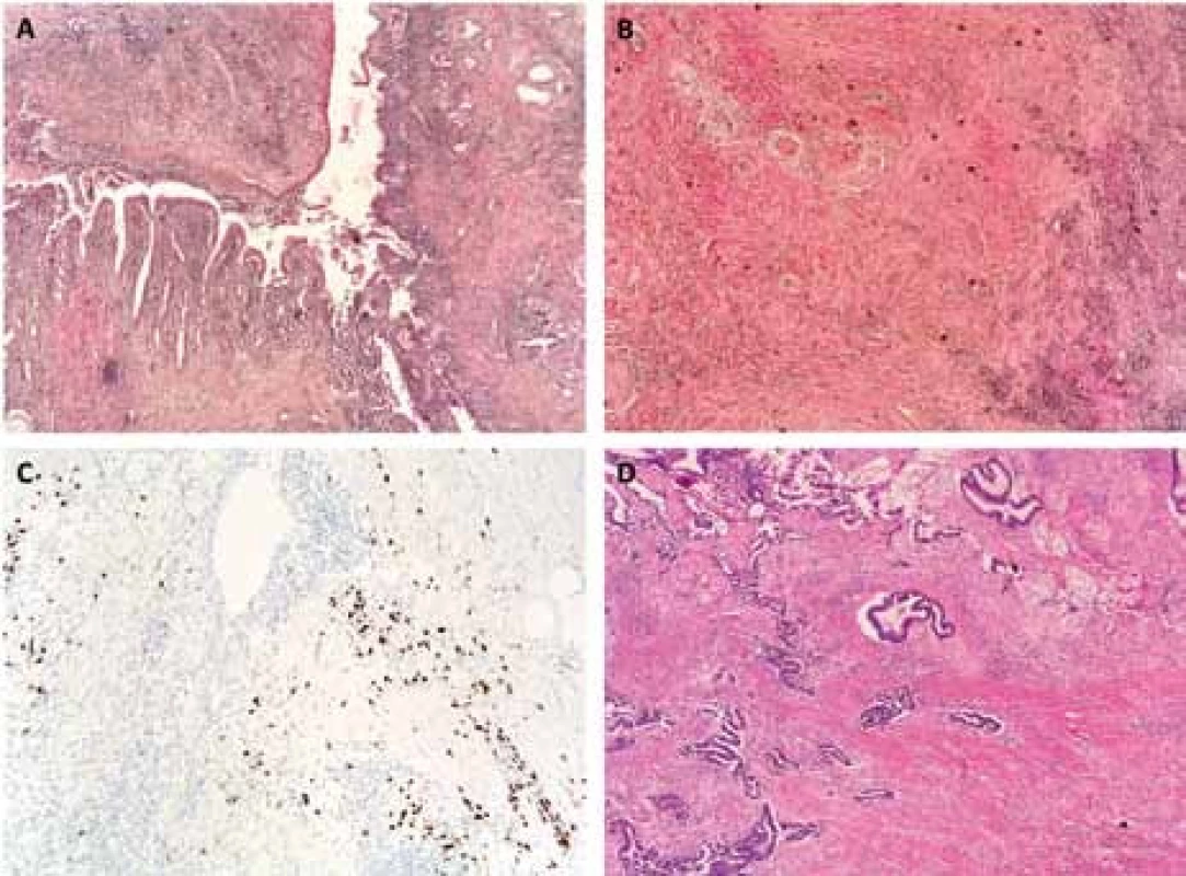 Histologický nález v resekátu pankreatu u pacienta s karcinomem pankreatu v terénu autoimunitní pankreatitidy (AIP + CP): A – AIP, barvení hematoxylin- eozin (HE), zvětšení 40×; B – AIP, storiformní fibróza, barvení HE, zvětšení 40×; C – AIP, imunohistochemický průkaz IgG4+ plazmocytů; D – CP, barvení HE, zvětšení 40×.
Fig. 1. Histological findings in resected pancreatic tissue in patient with synchronous presence of autoimmune pancreatitis and pancreatic cancer (AIP + CP): A – AIP, hematoxylin- eosin (HE) staining, original magnification ×40; B – AIP, storiform fibrosis, HE staining, original magnification ×40; C – AIP, immunohistochemical staining for IgG4+ plasma cells; D – CP, HE staining, original magnification ×40.
