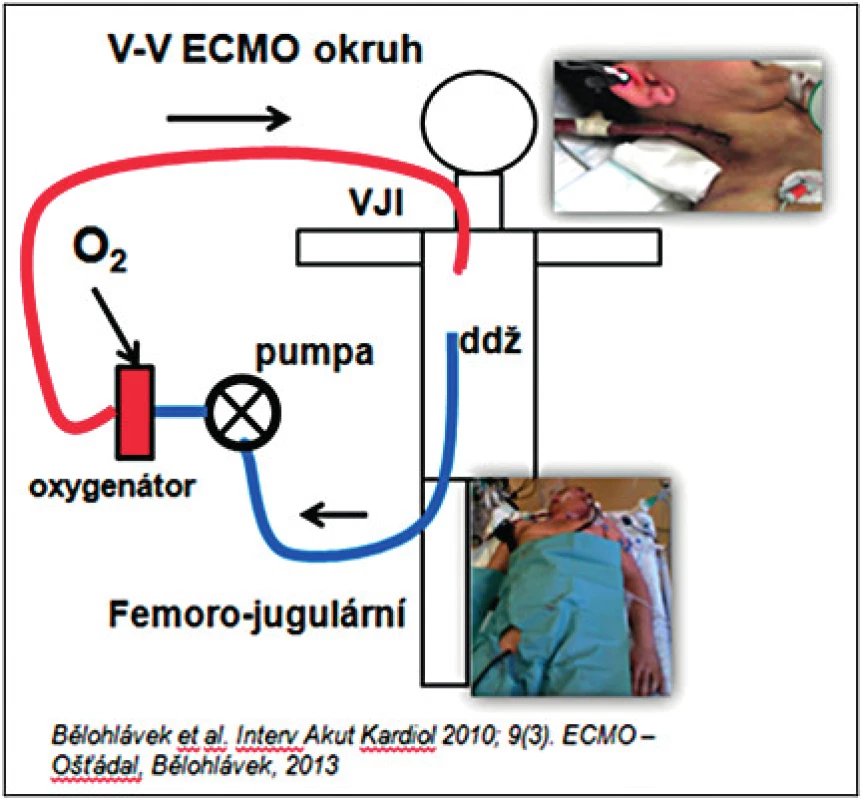 VV ECMO (femoro-jugulární okruh – přes kanylu cestou v. femoralis zavedenou do dolní duté žíly je odebírána krev do mimotělního okruhu, oxygenovaná a navracena cestou jugulární žíly).
VV ECMO – venovenózní extrakorporální mimotělní oběh, VJI – vena jugularis interna, ddž – dolní dutá žíla