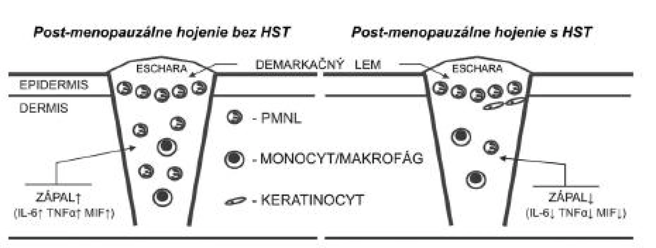 Hojenie rán v post-menopauzálnom období je charakteristické zvýšenou zápalovou reakciou organizmu, čo je založené na chýbajúcom inhibičnom efekte estrogénu na kľúčové zápalové faktory ako IL-6, TNF-α a MIF. HST inhibuje expresiu týchto mediátorov, a tým skracuje zápalovú fázu hojenia. HST – hormonálna substitučná terapia, IL-6 – interleukín 6, MIF – faktor inhibujúci migráciu makrofágov, TNF-α – tumor nekrotizujúci faktor alfa, PMNL – polymorfonukleárny leukocyt