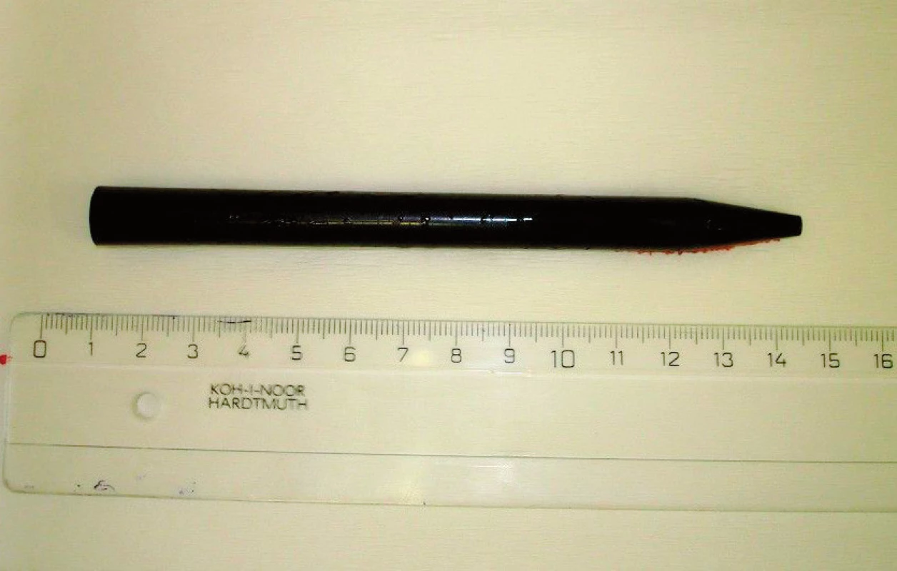 Propisovací tužka extrahovaná z uretry u pacienta 5
Fig. 5. Extracted pen from urethra by patient 5