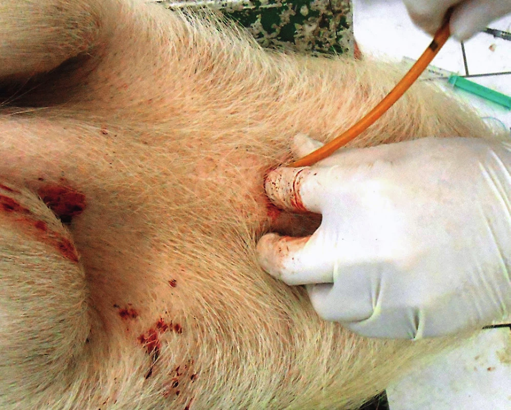 Tracheální rourka přetažena přes bužii do trachey a připojena k samorozpínacímu vaku
