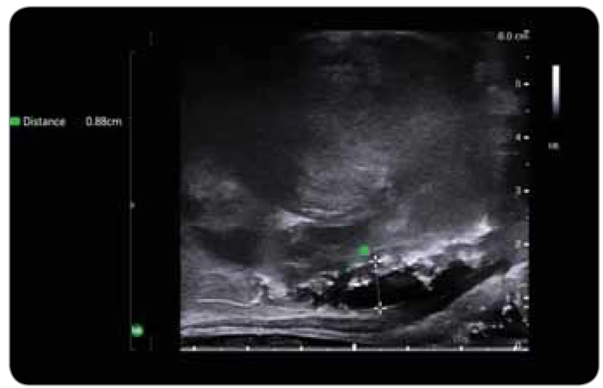 a. Měření vzdálenosti mezi přední stěnou rekta a zadní
částí prostaty v sagitální rovině po aplikaci SpaceOAR® za využití
biplanární transrektální sondy.