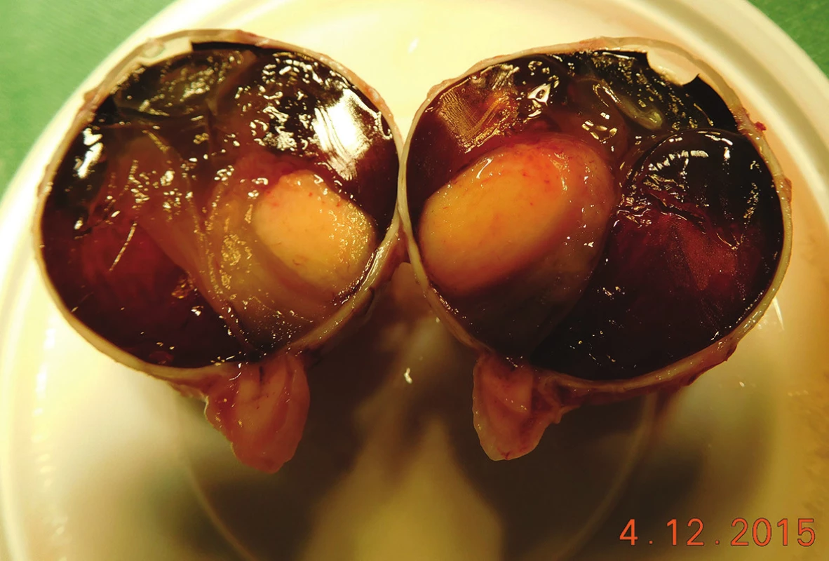 Pacient č. 20 - Makrofoto enukleovanej očnej gule po enukleácii pre MMCH; histopatologicky sa jedná o vretenobunkový typ B, ktorý prerastá do povrchu steny bulbu, bez propagácie do n. opticus