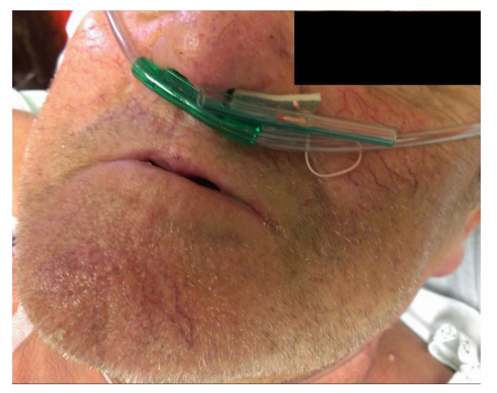 Prevence migrace stentu − ukotvení stentu před
nosní dírkou<br>
Fig. 2: Prevention of stent migration − anchoring of the
stent in front of the nostril