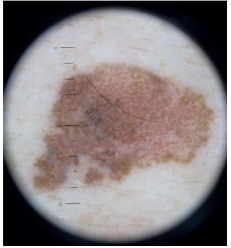 Dermatoskopický obraz
Nepravidelně konfigurovaný světle hnědě pigmentovaný projev s našedlými okrsky v dolním pólu, bílá homogenní pigmentace typu jizvení, inverzní pigmentová síť, na periferii nepravidelně hnědé globule.