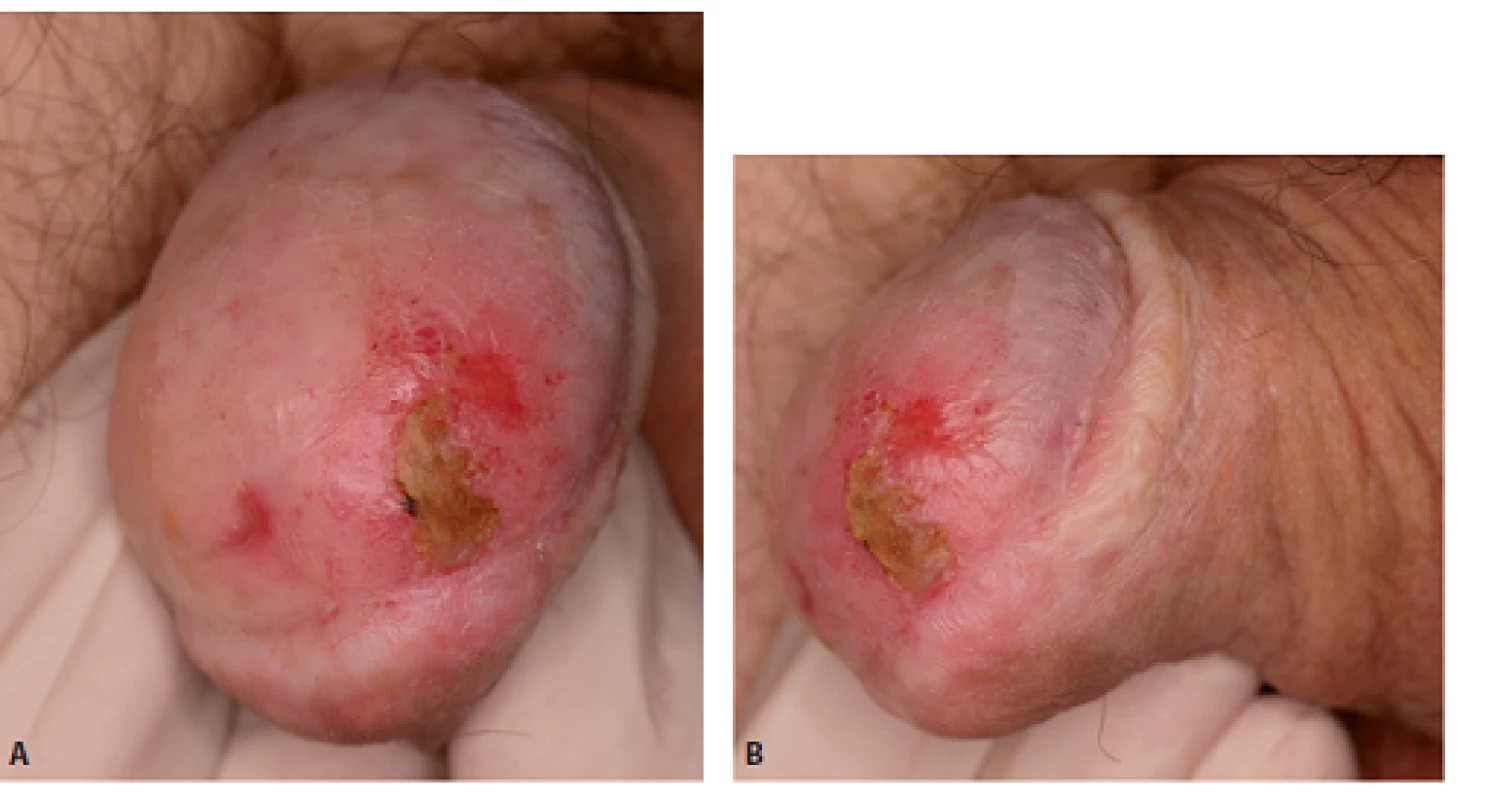 Muž, 62 let, 3 roky po cirkumcizi, histologicky „balanitis xerotica obliterans“ (novou nomenklaturou lichen sclerosus). Nyní biopsie PeIN a dlaždicobuněčný karcinom pT1, provedena glansektomie mj. i pro těžkou stenózu zevního ústí uretry. Defi nitivní histologie pT2G2, pozitivní okraje (čepy tumoru v uretře v oblasti spongiózního tělesa). Proto ve druhé době provedena totální amputace penisu a excize značených sentinelových uzlin, histologie pT0pN0.
Fig. 4. Man, 62-year-old, biopsy – PeIN and squamous cancer pT1. Glansectomy was performed, fi nal histology pT2G2, positive margins in urethra – in corpusa spongiosum.Total amputation and excision of sentinel lymph nodes
followed, histology pT0pN0.