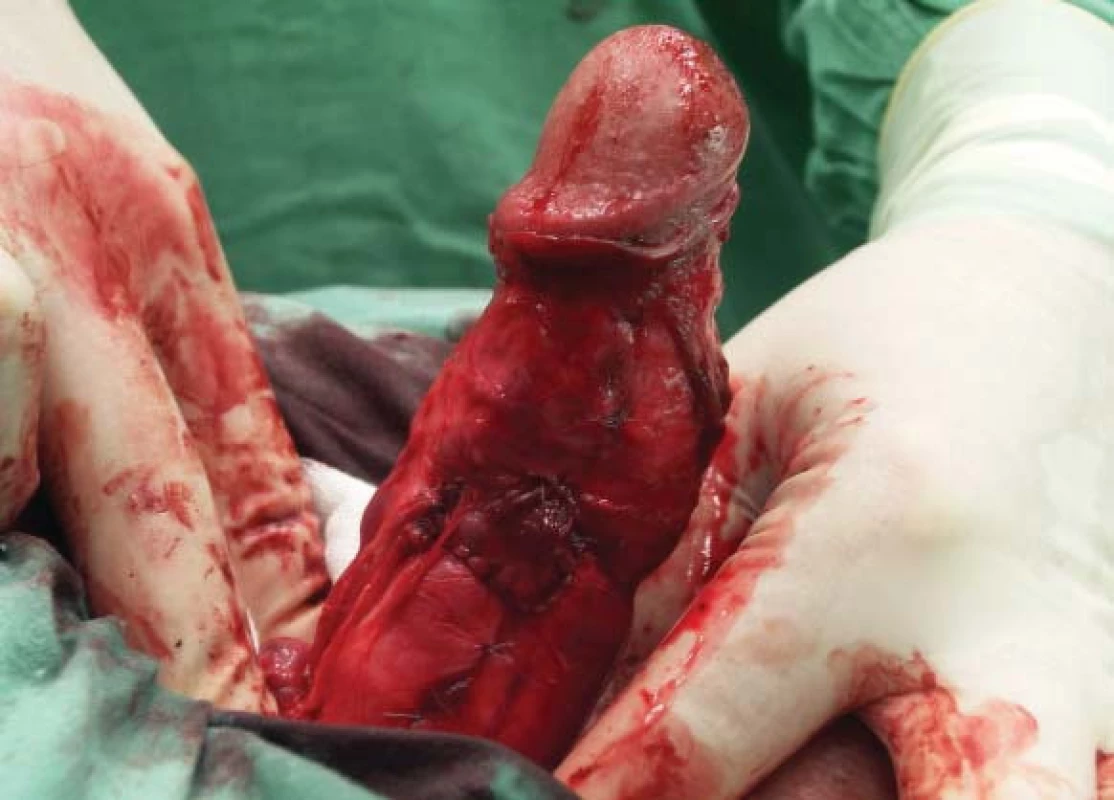 Narovnaný penis při arteficiální erekci po našití záplaty.