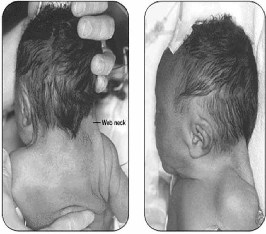 Pterygium colli a nízká vlasová hranice u novorozence (archiv autorů).
Fig. 3. Pterygium colli and low hair border in a newborn (authors’ archive).