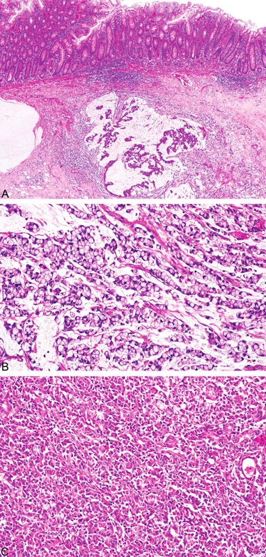 Adenokarcinom tlustého střeva u pacienta s HNPCC/Lynchovým syndromem s typickými morfologickými nálezy, tj. mucinózní charakter, peri- a intratumorální infiltrace lymfocyty (A), přítomnost prstenčitých buněk (B) a medulární růst (C)