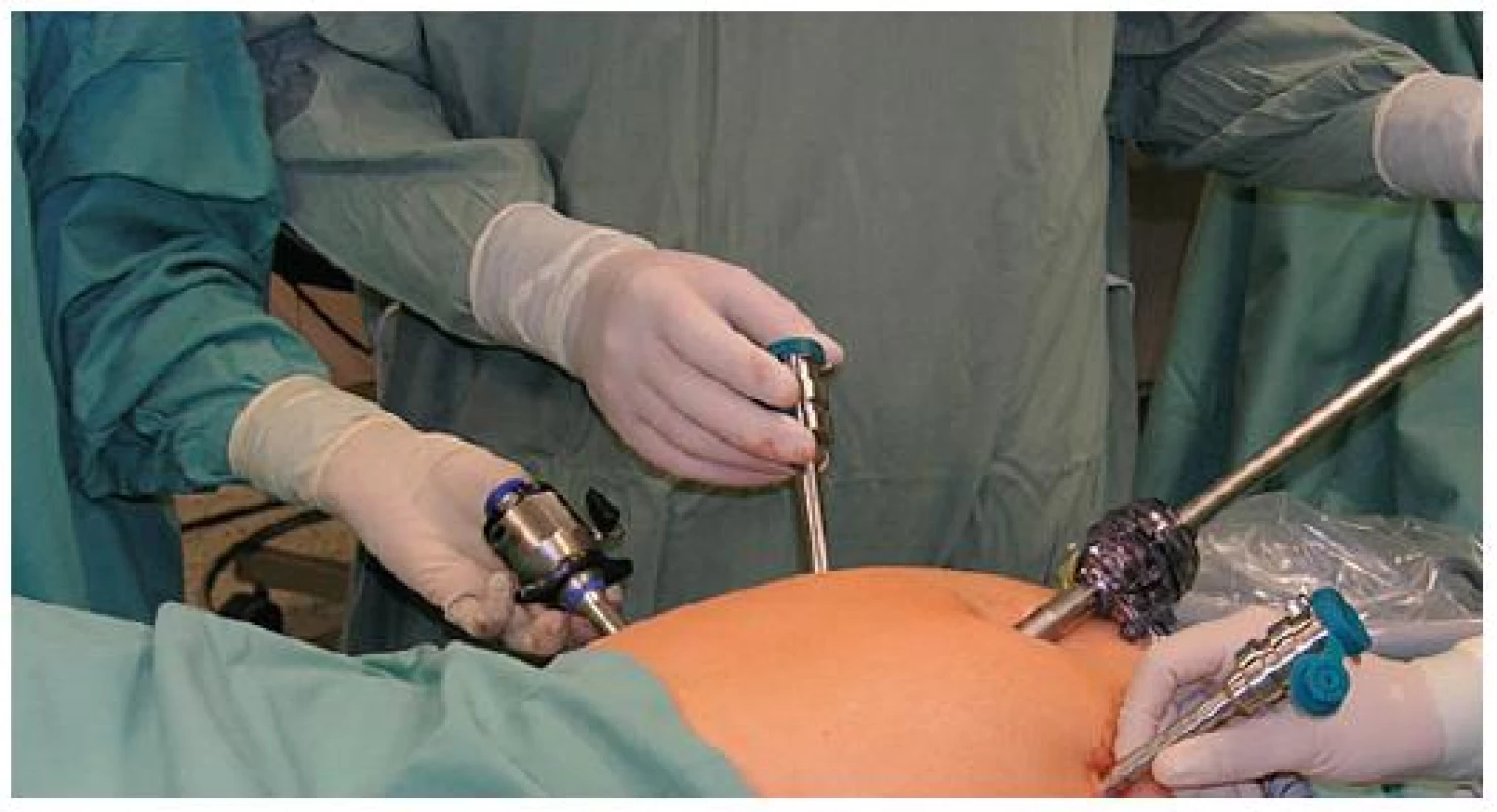 Umístění portů při robotické operaci karcinomu endometria