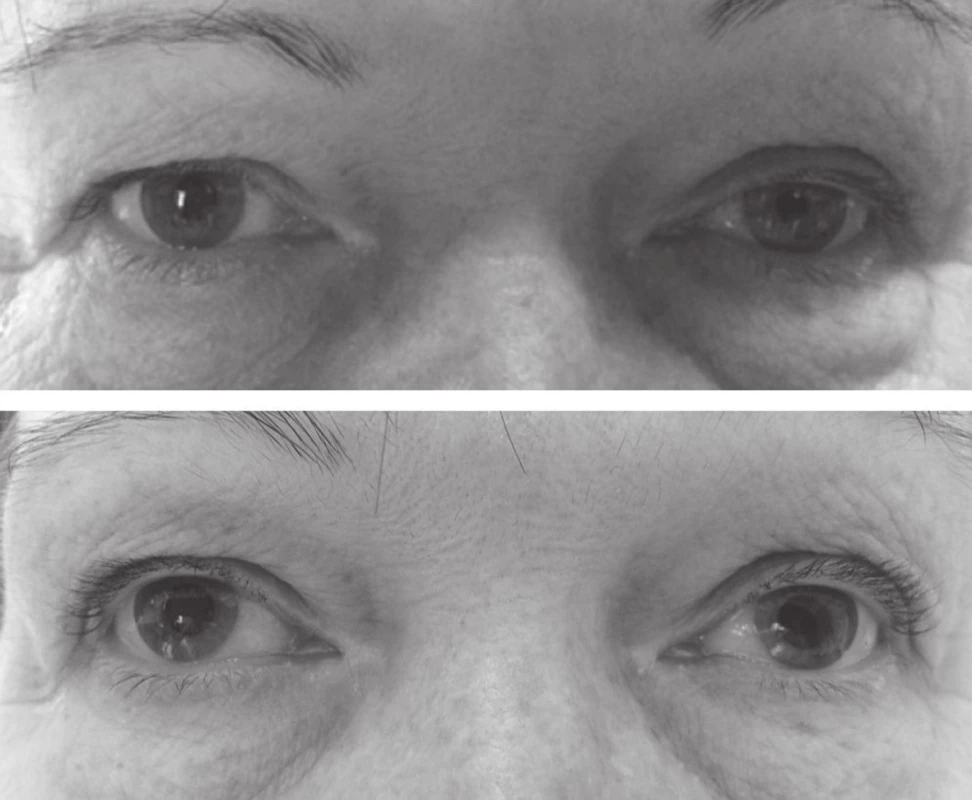 Průměr zornice pravého oka byl před aplikací 1% fenylefrinu 5 mm, levého oka 3 mm (nahoře). Hodinu po aplikaci 1% fenylefrinu se průměr zornice pravého oka nezměnil, na levém oku se zornice rozšířila a rovněž se zlepšil pokles horního víčka vlevo (dole). Výsledek testu ukázal na postganglionární lézi sympatiku vlevo