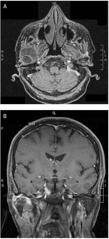 Magnetická rezonance lebky před operací (a, b)