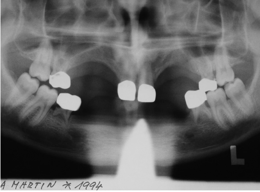 14letý pacient připravený k implantaci při využití včasné diagnostiky a perzistence dočasných zubů.