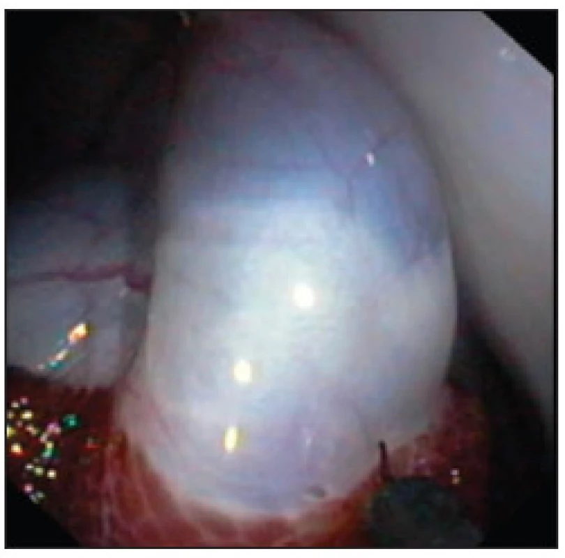 Disekce žlučníku z lůžka pomocí hook knife po podpichu fyziologickým roztokem 
Fig. 3. Dissection of the gall bladder after saline injection